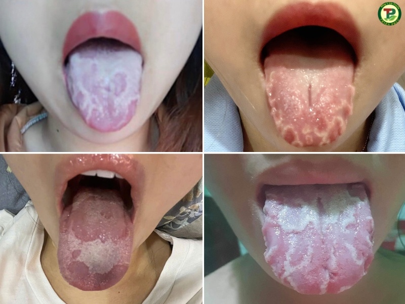 Viêm lưỡi bản đồ thường gặp